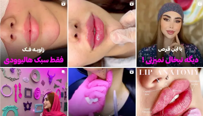 بهترین مرکز تزریق ژل لب قم