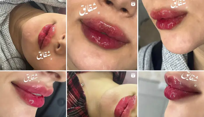 تزریق ژل لب بست ژل قم 