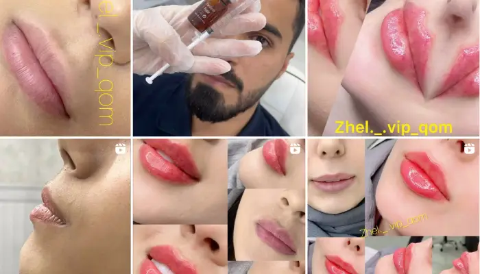 تزریق ژل لب قم
